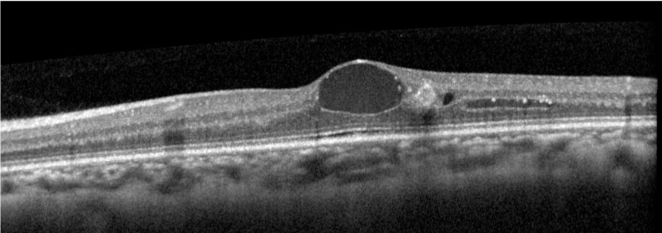 diabetic-eye-disease-when-to-intervene-retina-today